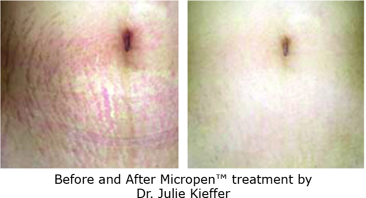 scar removal with laser