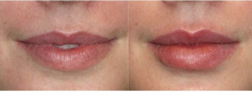 Lip filler before and after