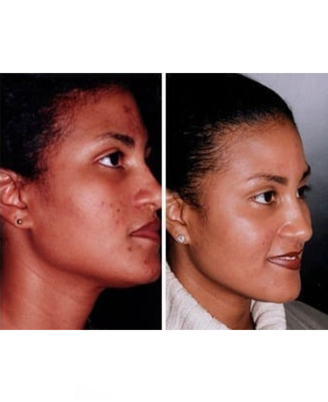 chemical peel for face