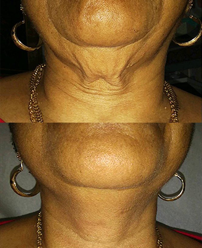 laser skin tightening