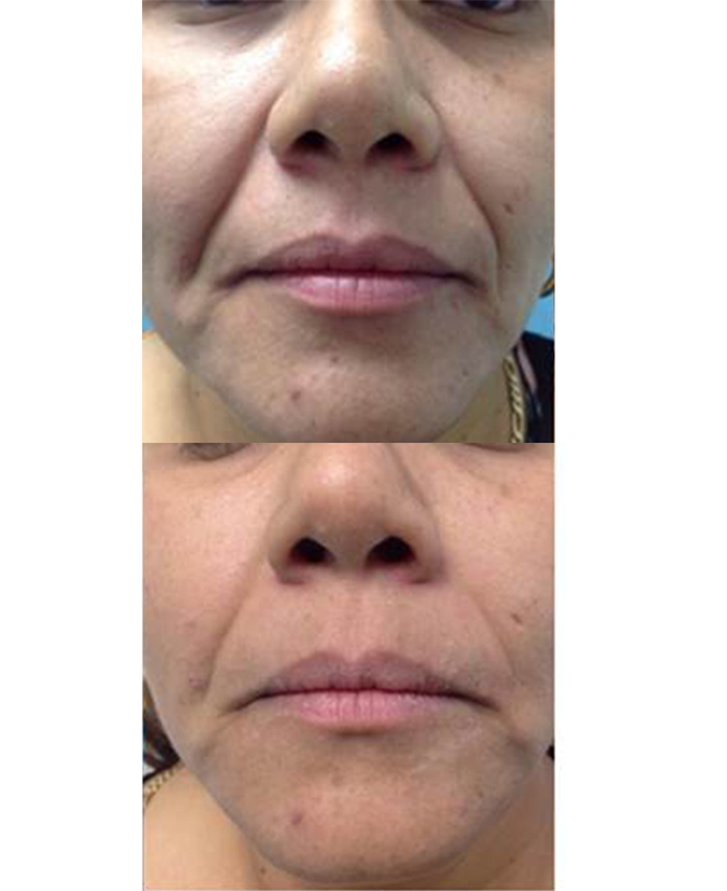 skin tightening laser