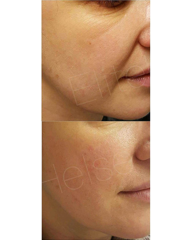 skin tightening by laser