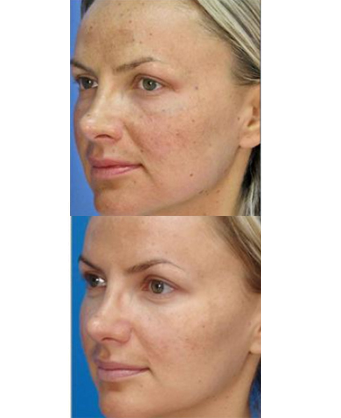 chemical peel for face