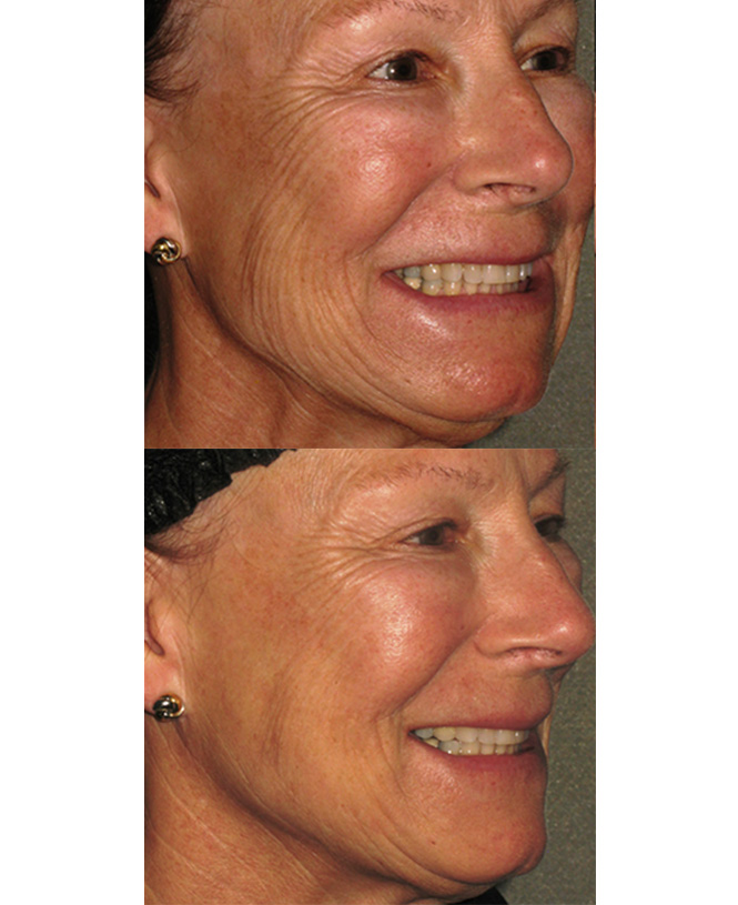 skin tightening by laser