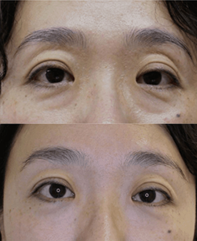 Do You Have Puffy Eyes And Dark Circles? - Costhetics