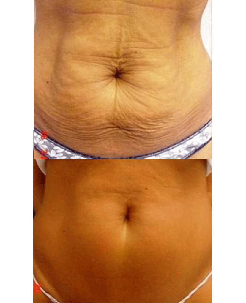 Does Nonsurgical Skin Tightening Work on Loose Skin Around the Waist?