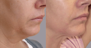 radio frequency skin tightening