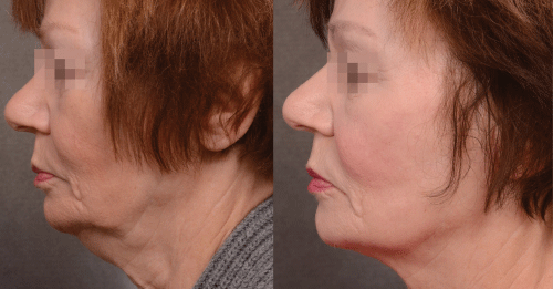 radio frequency skin tightening