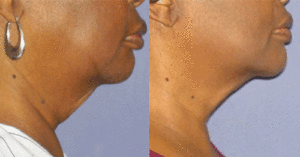 radio frequency skin tightening