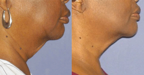 radio frequency skin tightening