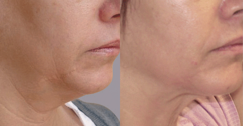 radio frequency skin tightening