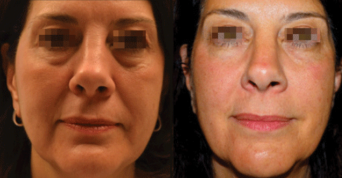 radio frequency skin tightening