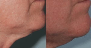 radio frequency skin tightening