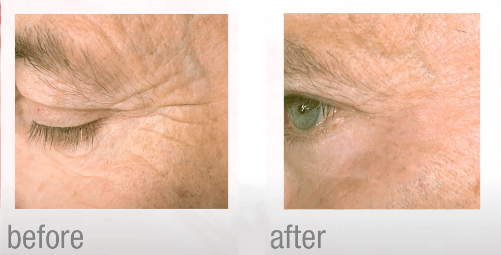 laser for skin resurfacing