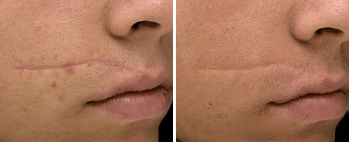 scar removal with laser