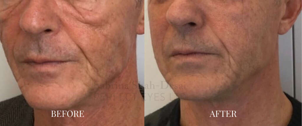 Morpheus8 Microneedling Before And After Men Medispa Physimed 
