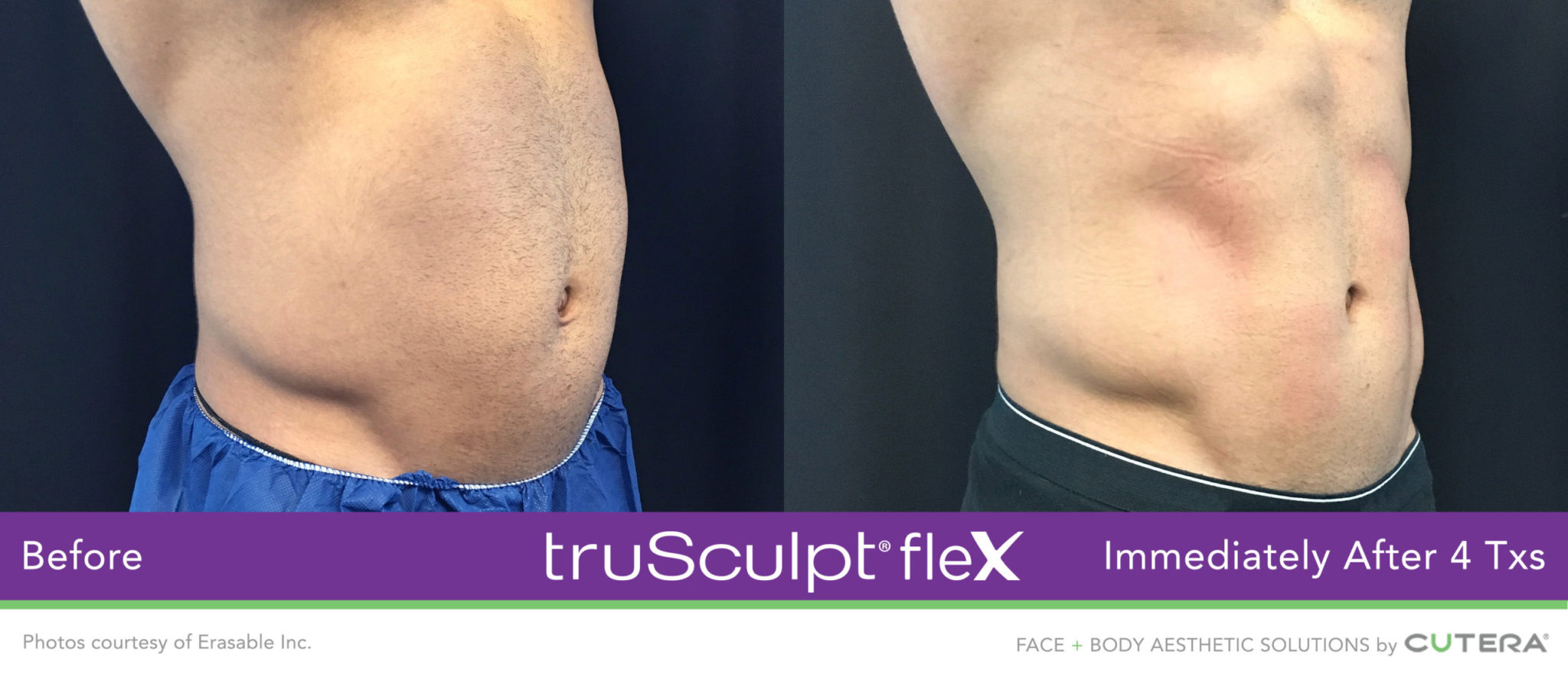 Body contouring with TruBody, Men