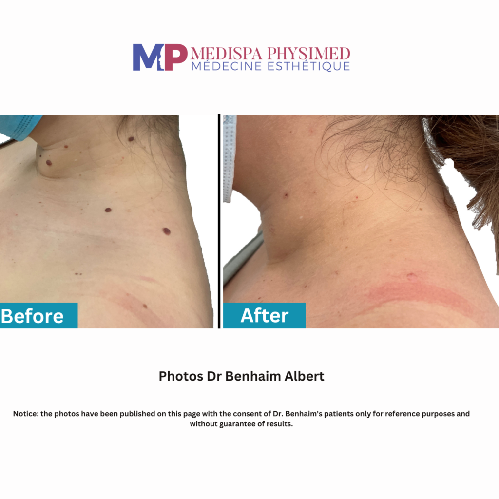 before and after mole removal at Medispa Physimed in Montreal